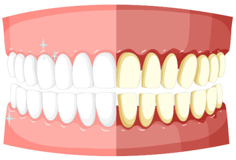 Periodontitis