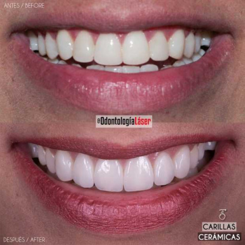 ¿El diseño de sonrisa daña tus dientes?