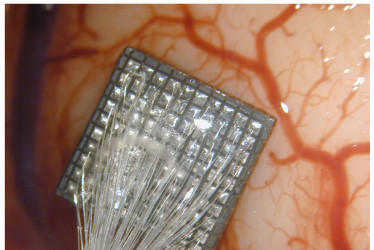 Matriz de 100 microelectrodos en la corteza cerebral humana.