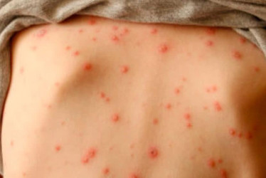 Las autoridades sanitarias de Colombia confirmaron este viernes los tres primeros casos de sarampión detectados en los últimos diez años en el país.