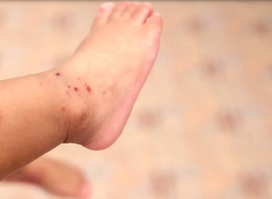 La Secretaría de Salud Pública de Manizales ha identificado algunos casos de la enfermedad de manos, pies y boca en guarderías y jardines infantiles.