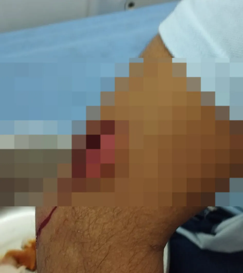 En el antebrazo derecho fue herido con arma blanca el dragoneante del Inpec.