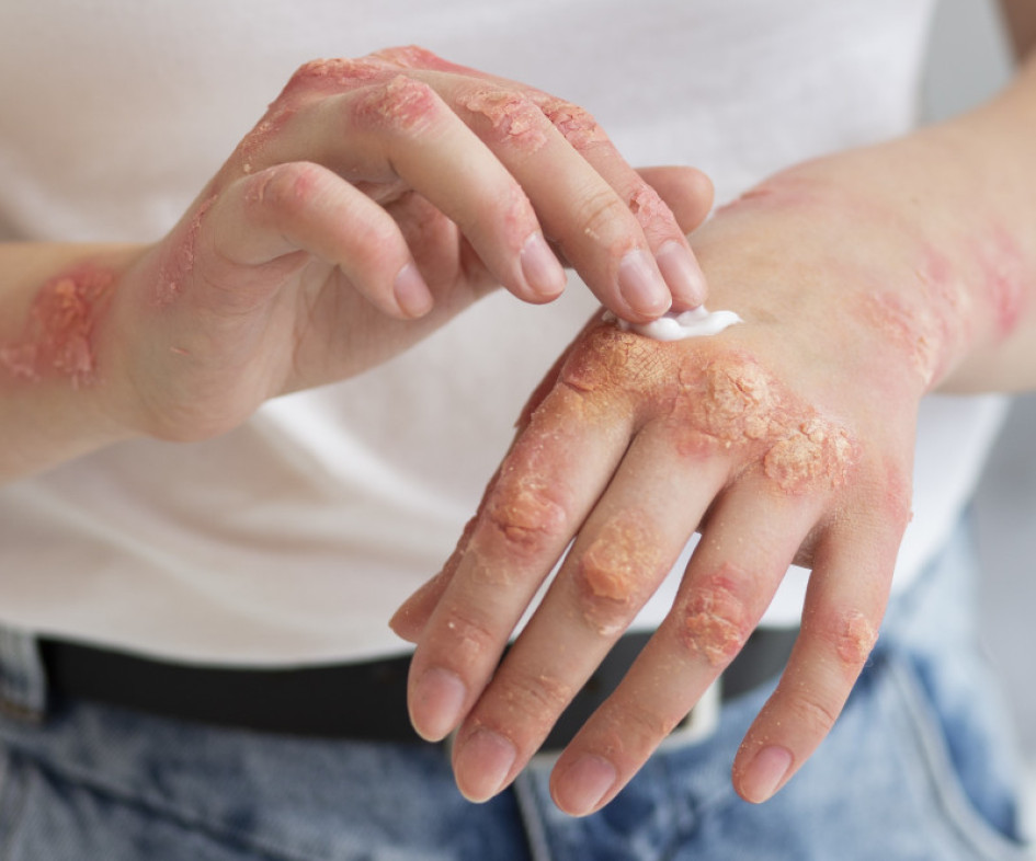 SES Hospital Universitario de Caldas